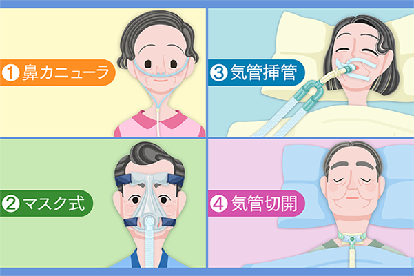 情報BOX】「人工呼吸器装着＝気管切開」とは限らない 人工呼吸器って 